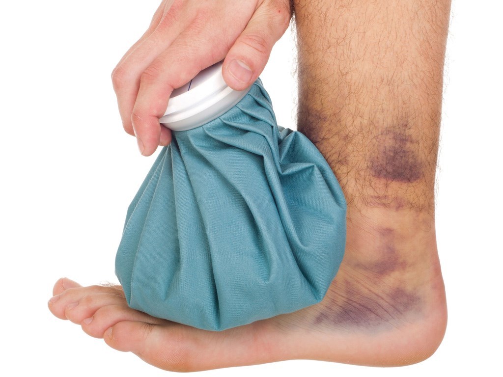 Tips For Bruise Treatment Sir Health