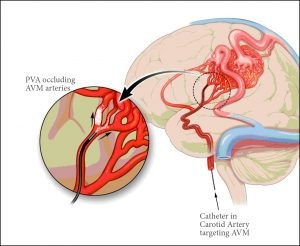 Stroke can cause paralysis, coma and even death