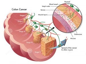 Colorectal cancer