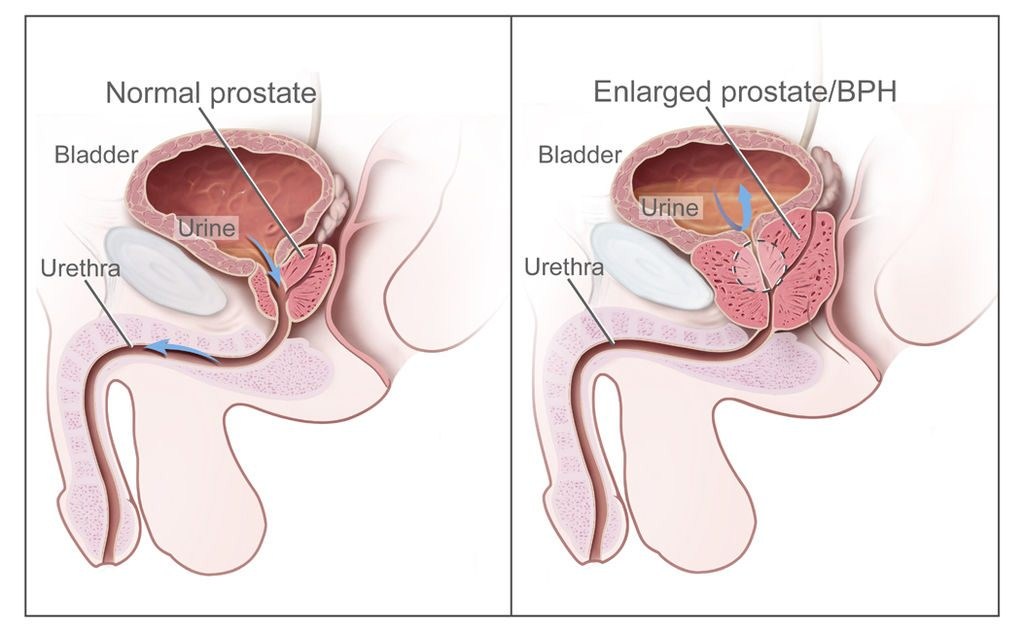 Prostate cancer (also known as carcinoma of the prostate)